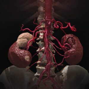 CT Nierentumor mit 3D Gefäßdarstellung der abdominellen Gefäße. Foto: Canon Medical 