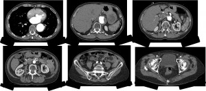 CT Angiographie der Aorta mit Aneurysma. Foto: Canon Medical